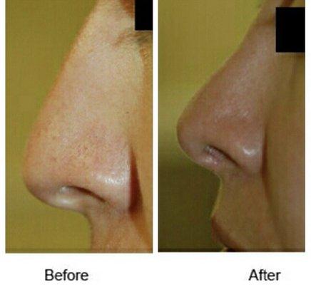 Rhinoplasty