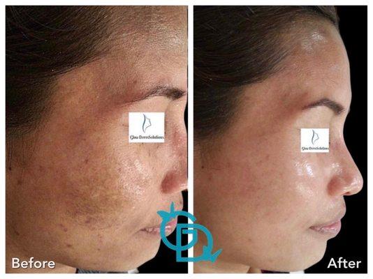 Before after for hyperpigmentation and rejuvenation