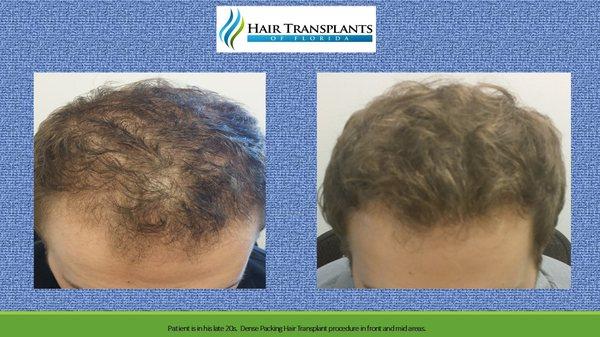 27 year old patient with diffused hair loss in front and mid areas. Performed 1 dense packing hair transplant procedure and also Propecia.