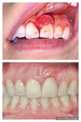 Regenerative Periodontal Plastic Surgery