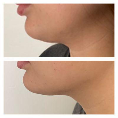 1 vial of kybella