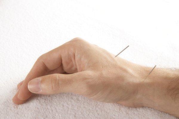 Pain-free acupuncture therapy  to improve your life.