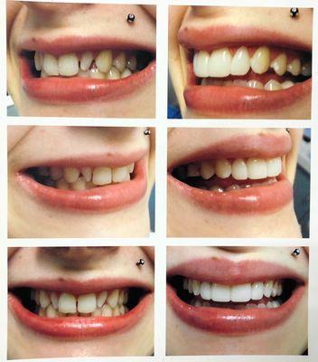 No prep Veneers to instantly transform your smile!