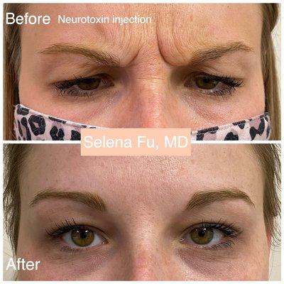 Neurotoxin / Botox before and after