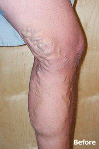 Patient 7 - varicose vein treatment BEFORE