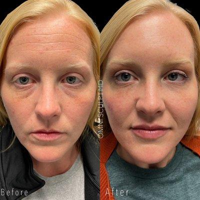 Wow!!! Dr. DeGironemo strategically placed Botox and filler to achieve this amazing transformation