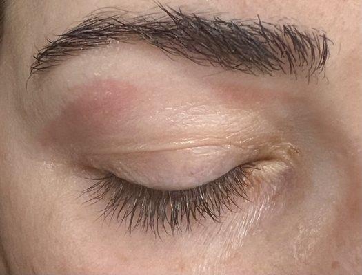 Raw skin after a brow wax