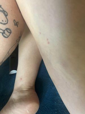 Bed bug bites (four people with the same looking bites)