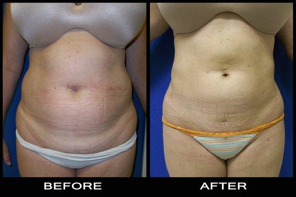 Liposuction