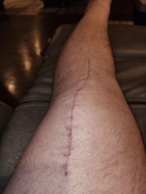 Left knee 3 weeks after replacement