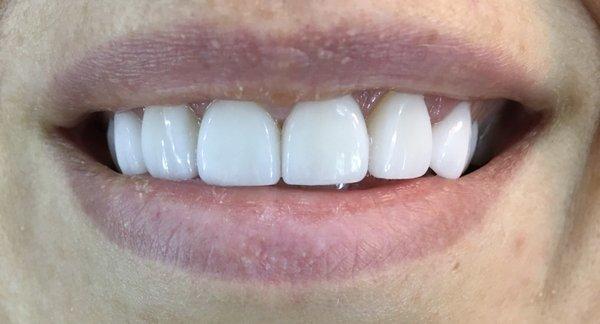 Permanent veneers front