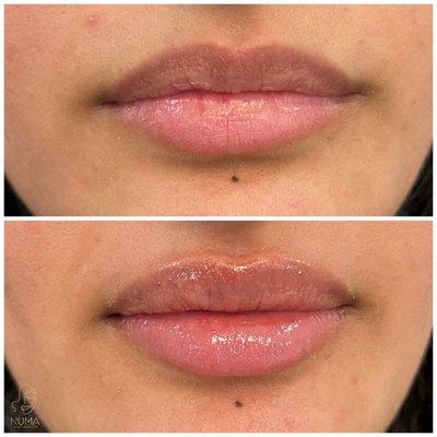 Lip enhancement using microcannula. **no bruising**