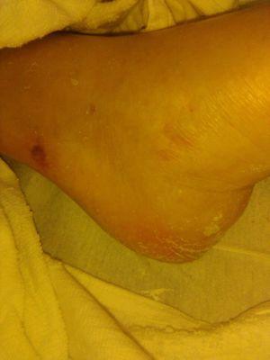 Some of many bed soars and bruises mother received at Care One Valley while there as a short term patient. Horrible!