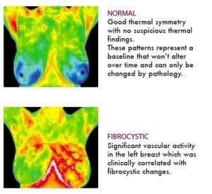 Thermography, Non-radiative method of detecting breast and body abnormalities