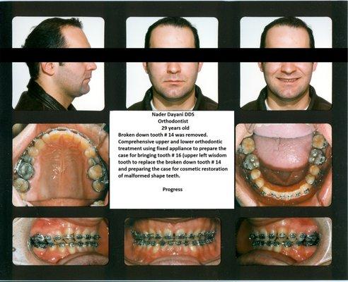 Ortho and veneers PROGRESS (1/2)