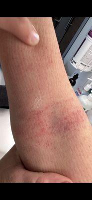 Bruising after 5 days with the cast