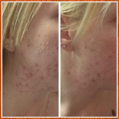 before and after 3 acne treatments