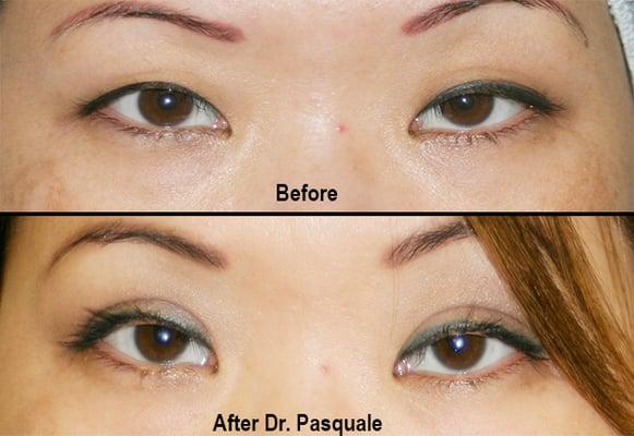 Asian Eyelid Surgery  Dr Michael Pasquale