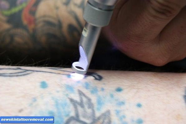 NewSkin Tattoo Removal