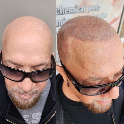 Scalp Micropigmentation full head treatment