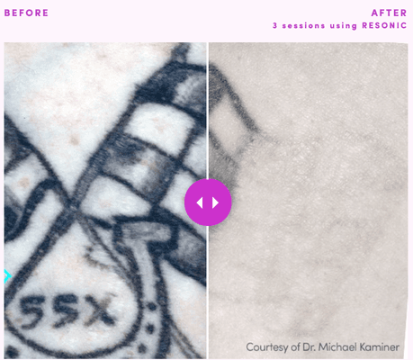 RESONIC Tattoo Removal in Nashville, TN