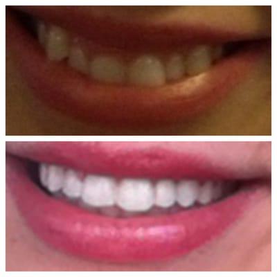 Before and after 6 month braces. I could not be happier! Dr. Freedman and his staff gave me the smile I always dreamed of.