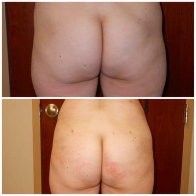 Smart Lipo Before and After (with Fat Transfer).