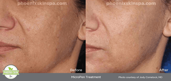 Micro-Needling