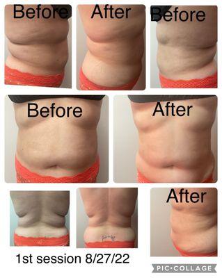 Before and after pictures of Body Sculpting Session