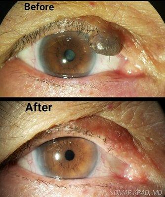 The patient's cataract and eyelid lesion were removed