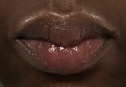 My lips after seeing Dr. Jackson