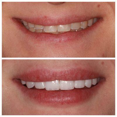 10 Porcelain Veneers Before & After