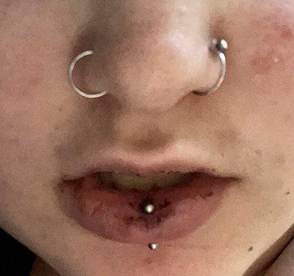 Vertical Labret piercing 4 days after