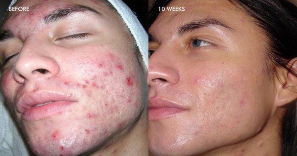 Got Acne? Try Dermalinfusion to clinically treat visible lesions and post acne redness and brown spots.