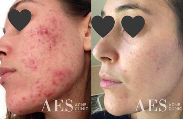 AES Acne Clinic