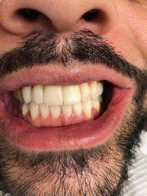 Beautiful Smile by Dr. Dabek Crowns and Implant Bridge