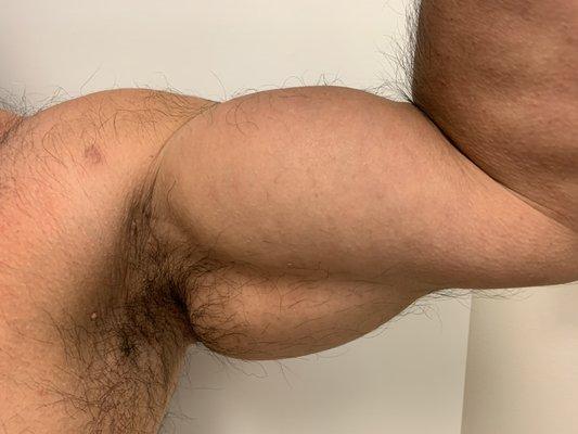 Biceps and triceps implants