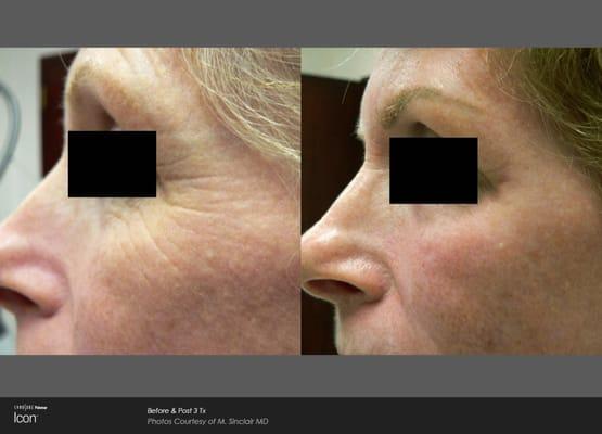 Before and After Icon Laser Wrinkle Treatment