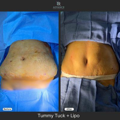 Tummy Tuck with Liposuction