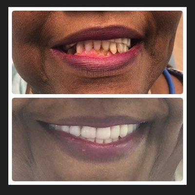 Before and after photo from one of our patients. Dr. Schmitt completed extractions, implant placements and full upper and lower dentures.