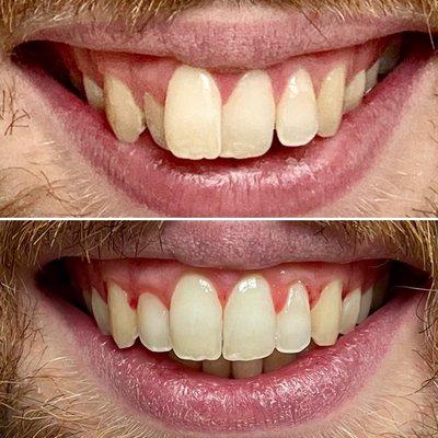 Before and After Invisalign treatment at Vida Dental