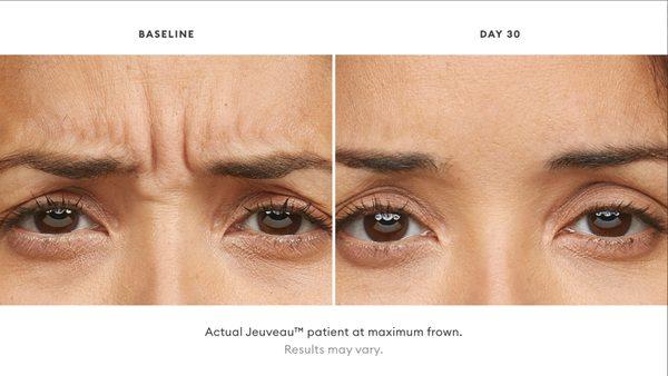 Actual Jeuveau patient at maximum frown. Results may vary.
 https://alamodemedspa.com/