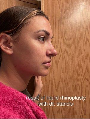 bulbous nose as a result of liquid rhinoplasty injection with dr. stanciu