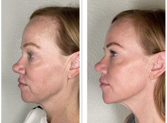 Morpheus8 skin rejuvenation result