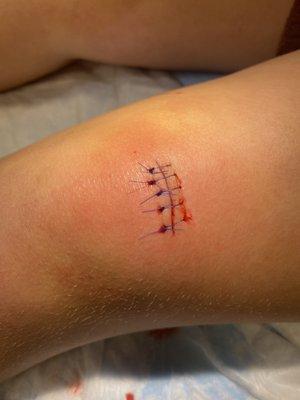 Sutures above the knee