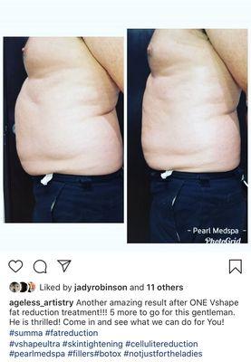 Look what 1 single VShape session did for him!?! What can it do for you?