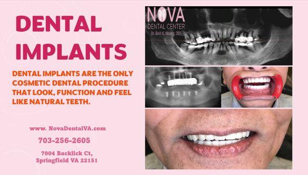 Dental implants