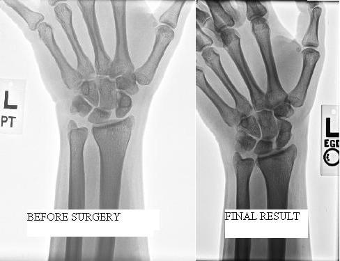 These are my before surgery and final result x rays with Dr. Horner as my surgeon.