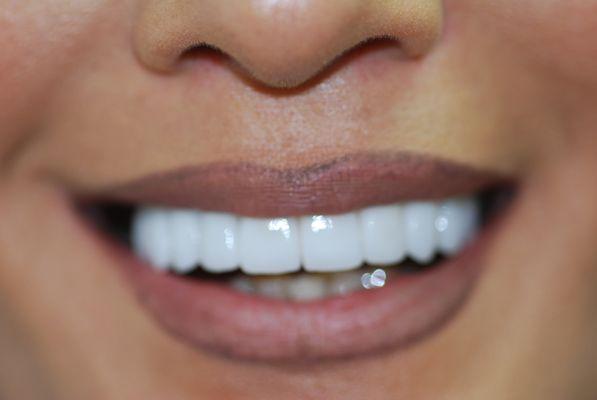 After upper Veneers and Implant