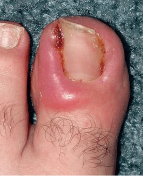 toenail surgery $280